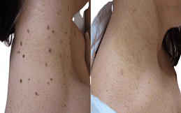 Skin Tag Removal before after in Islamabad