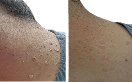 Skin Tag Removal cost inIslamabad