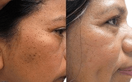 Skin Tag Removal in Islamaabd,Pakistan