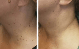 Skin Tag Removal in Islamabad