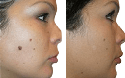 Skin Tag Removal result in Islamabad
