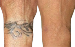 Tattoo Removal in Islamabad