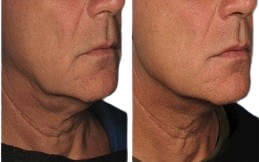 Ultherapy Treatment before after in Islamabad