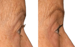 Ultherapy Treatment cost in Islamabad