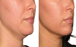 Ultherapy Treatment in Islamabad