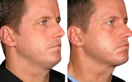 Ultherapy Treatment in Islamabad,Pakistan