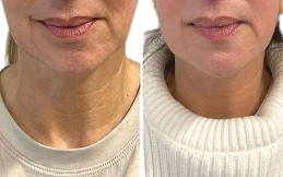 Ultherapy Treatment result in Islamabad