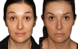 Xeomin Treatment before after in Islamabad
