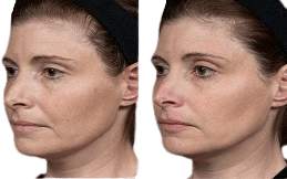 Xeomin Treatment cost in Islamabad