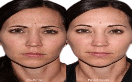 Xeomin Treatment in Islamabad