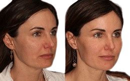 Xeomin Treatment result in Islamabad