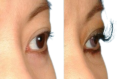 eyelash hair transplant before and after in Islamabad