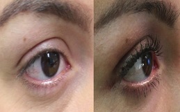 eyelash hair transplant cost in Islamabad