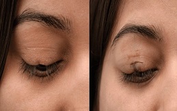 eyelash hair transplant in Islamabad