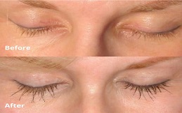 eyelash hair transplant in Islamabad,Pakistan