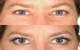 eyelash hair transplant result in Islamabad