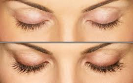 eyelash hair transplant