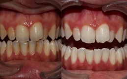 Teeth cleaning before and after