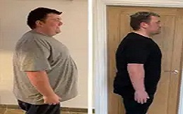 Bariatric Surgery before after in Islamabad