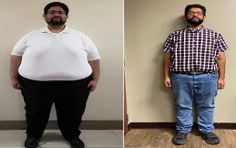 Bariatric Surgery result in Islamabad