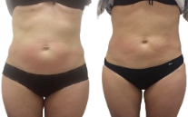 Body Jet Liposuction before after in Islamabad