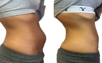 Body Jet Liposuction cost in Islamabad