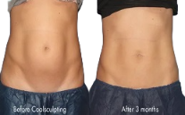 Body Jet Liposuction in Islamabad