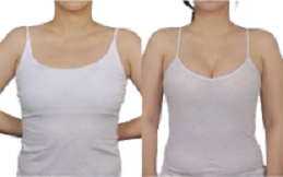 Breast Enhancement Surgery cost in Islamabad
