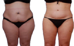Circumferential Abdominoplasty