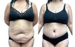 Circumferential Abdominoplasty cost in Islamabad
