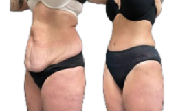 Circumferential Abdominoplasty in Islamabad