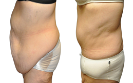 Lipo Abdominoplasty 