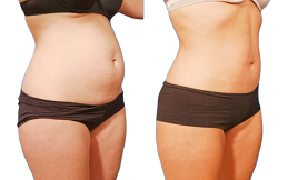 Lipo Abdominoplasty before after in Islamabad