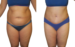 Lipo Abdominoplasty cost in Islamabad