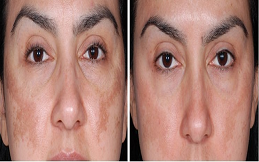 Melasma Treatment cost in Islamabad