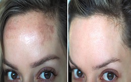 Melasma Treatment