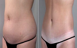 Mini Abdominoplasty before after in Islamabad