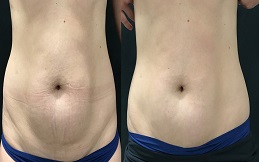 Mini Abdominoplasty cost in Islamabad