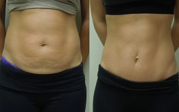 Mini Abdominoplasty in Islamabad