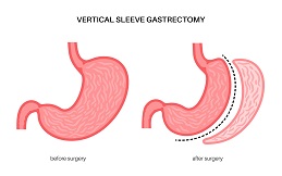 Sleeve Gastrectomy in Islamabad
