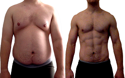 vaser 4d liposuction before and after in Islamabad