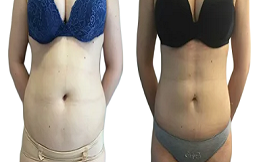 vaser 4d liposuction cost in Islamabad