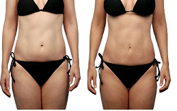 vaser 4d liposuction in Islamabad,Pakistan