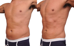 vaser 4d liposuction in Islamabad
