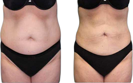 vaser 4d liposuction result in Islamabad