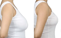 Breast Reduction Surgery