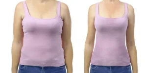 Breast Reduction Surgery in Islamabad