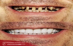Before after results of Dental Implant in Islamabad