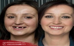 Dental Implants before after results