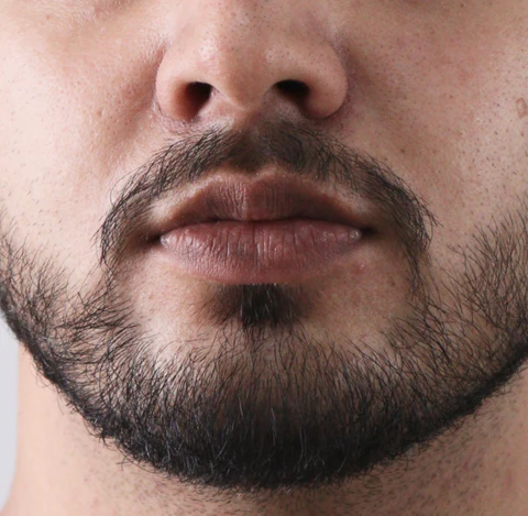 Smoker Lips Treatment in Islamabad